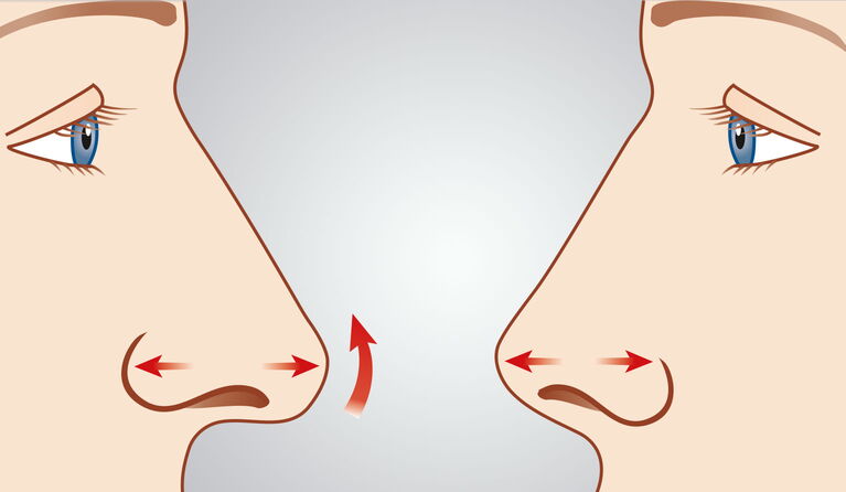 Correction of the tip of the nose teaser pictures