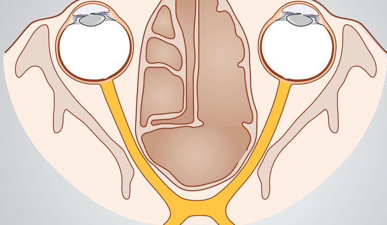 Optic nerve teaser picture