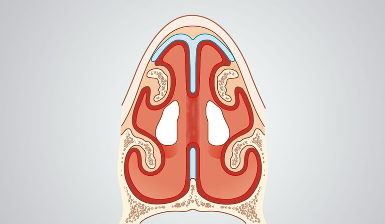 Septum perforation teaser pictures