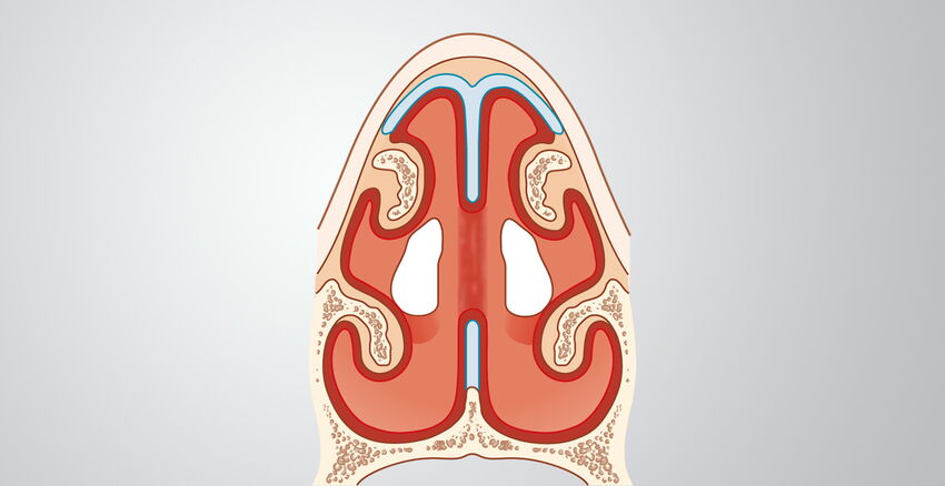 Septum perforation header picture