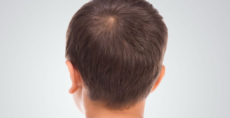 Earlobe pinning teaser picture