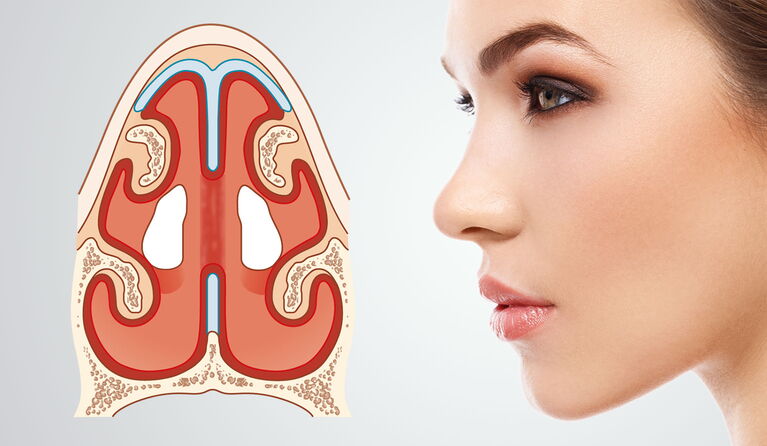 Sealing a perforation in the septum & nose correction teaser picture