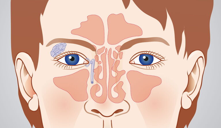 Tear duct Teaser picture