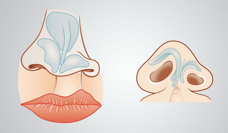 Cleft nose teaser pictures