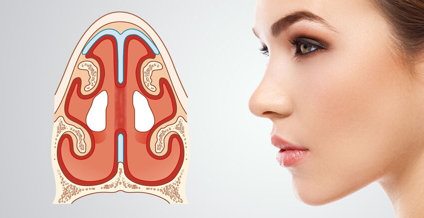 Sealing a perforation of the nasal septum &nose correction header picture