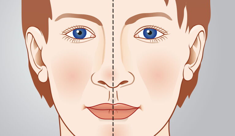 Nose straightening teaser pictures