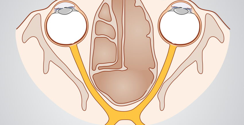 Optic nerve header picture