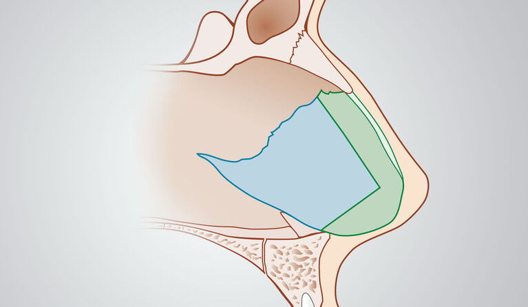 Nasal septum correction teaser picture